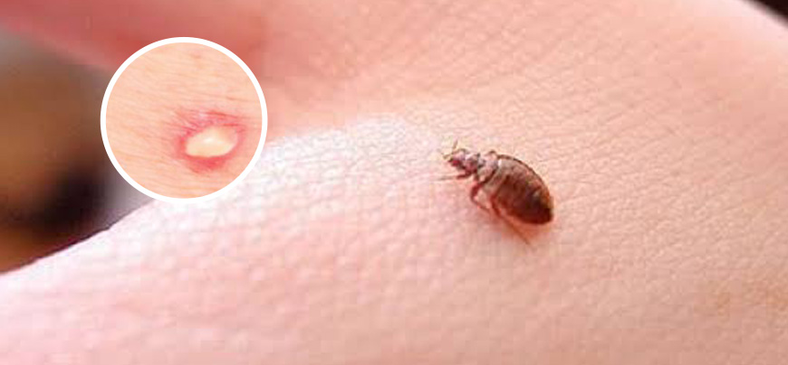 Bedbugs Concerning you? Here’s the solution